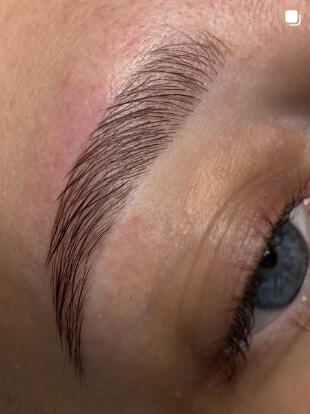 brow lift staffanstorp